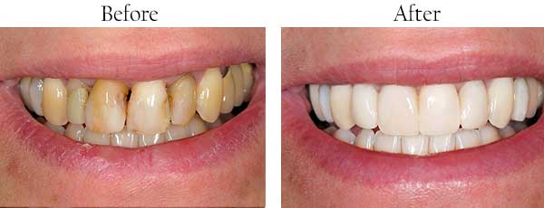 Irvington Before and After Teeth Whitening
