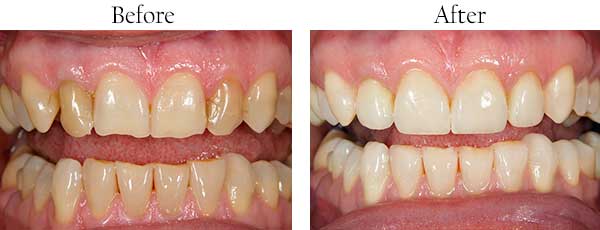 Warren Park Before and After Teeth Whitening