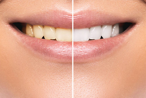 The image is a before-and-after comparison of a person s teeth, showcasing the results of a teeth whitening treatment.